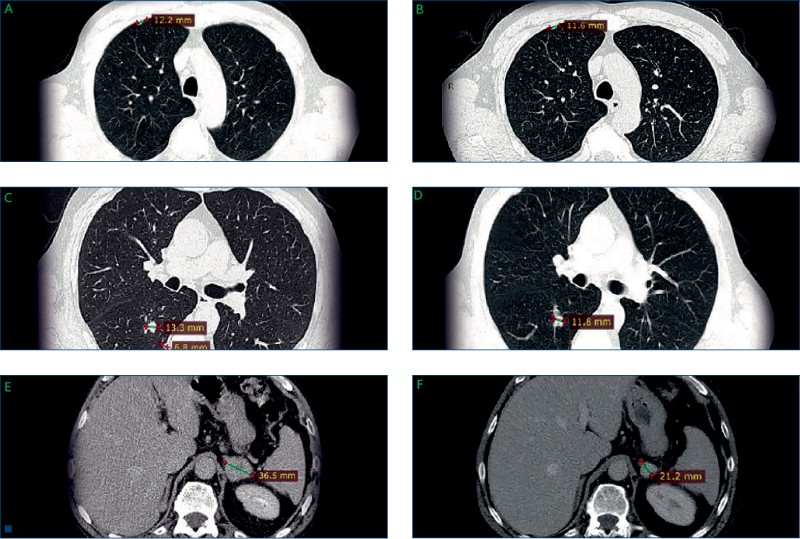 Figure 3. Pulmonary metastases (A and C) before and (B and D) during temsirolimus treatment. Left ad
