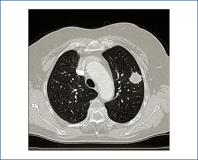 Figure 3. Spiculated aspect of the nodule; this aspect and the upper lobe localization, the history 