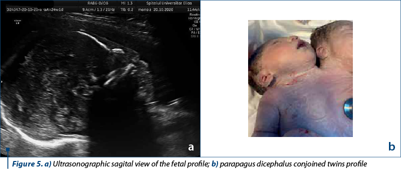 Figure 5. a) Ultrasonographic sagital view of the fetal profile; b) parapagus dicephalus conjoined twins profile