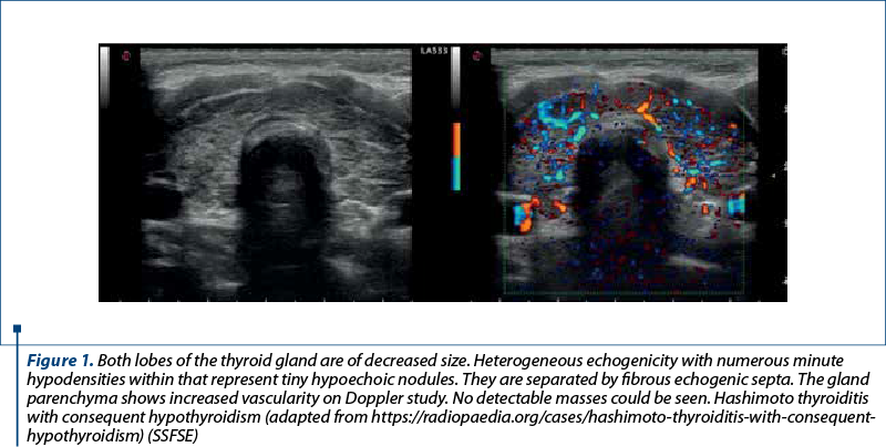 Figure 1. Both lobes of the thyroid gland are of decreased size. Heterogeneous echogenicity with numerous minute hypodensities within that represent tiny hypoechoic nodules. They are separated by fibrous echogenic septa. The gland parenchyma shows increased vascularity on Doppler study. No detectable masses could be seen. Hashimoto thyroiditis with consequent hypothyroidism (adapted from https://radiopaedia.org/cases/hashimoto-thyroiditis-with-consequent-hypothyroidism) (SSFSE)
