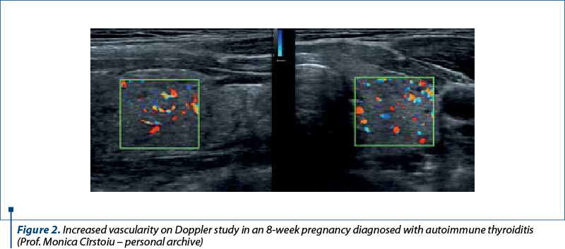 Figure 2. Increased vascularity on Doppler study in an 8-week pregnancy diagnosed with autoimmune thyroiditis  (Prof. Monica Cîrstoiu – personal archive)