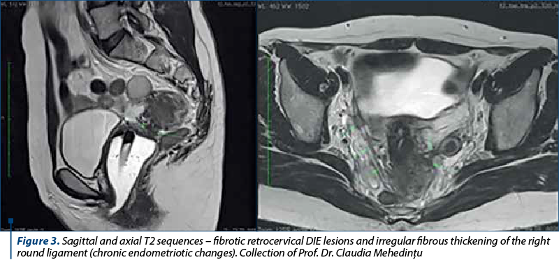 Figure 3. Sagittal and axial T2 sequences – fibrotic retrocervical DIE lesions and irregular fibrous thickening of the right round ligament (chronic endometriotic changes). Collection of Prof. Dr. Claudia Mehedinţu