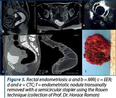 Figure 5. Rectal endometriosis: a and b = MRI; c = EER; d and e = CTC; f = endometriotic nodule transanally removed with a semicircular stapler using the Rouen technique (collection of Prof. Dr. Horace Roman)