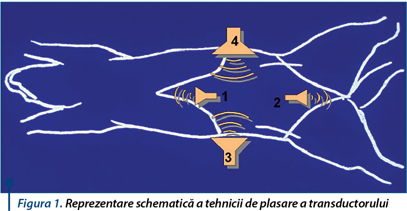 Figura 1. Reprezentare schematică a tehnicii de plasare a transductorului
