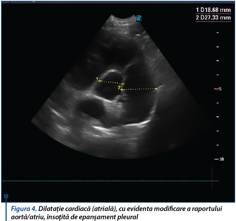 Figura 4. Dilatație cardiacă atrială cu evidenta modificare a raportului aortă