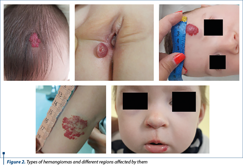 Figure 2. Types of hemangiomas and different regions affected by them