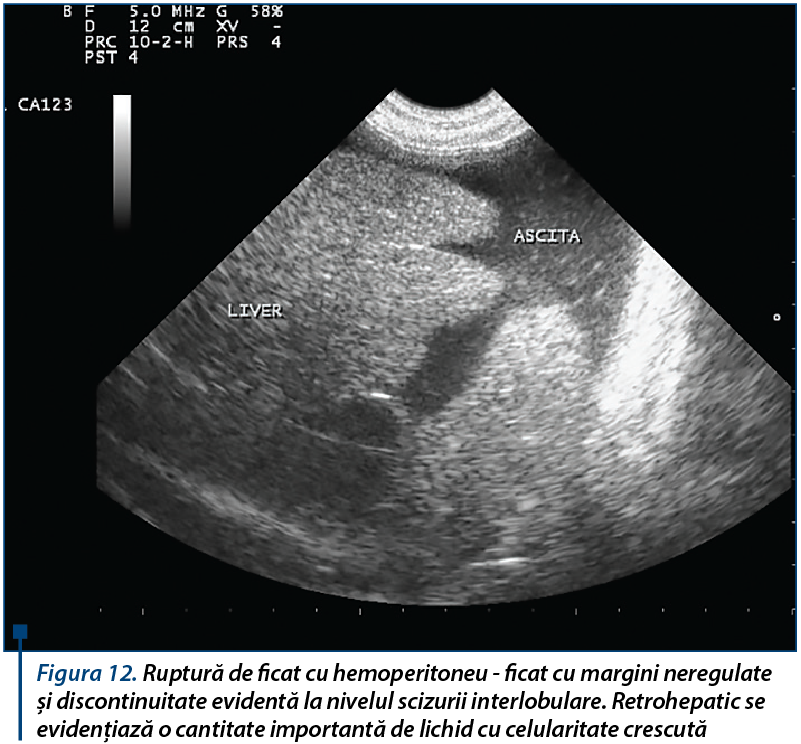 Figura 12. Ruptură de ficat cu hemoperitoneu - ficat cu margini neregulate și discontinuitate eviden