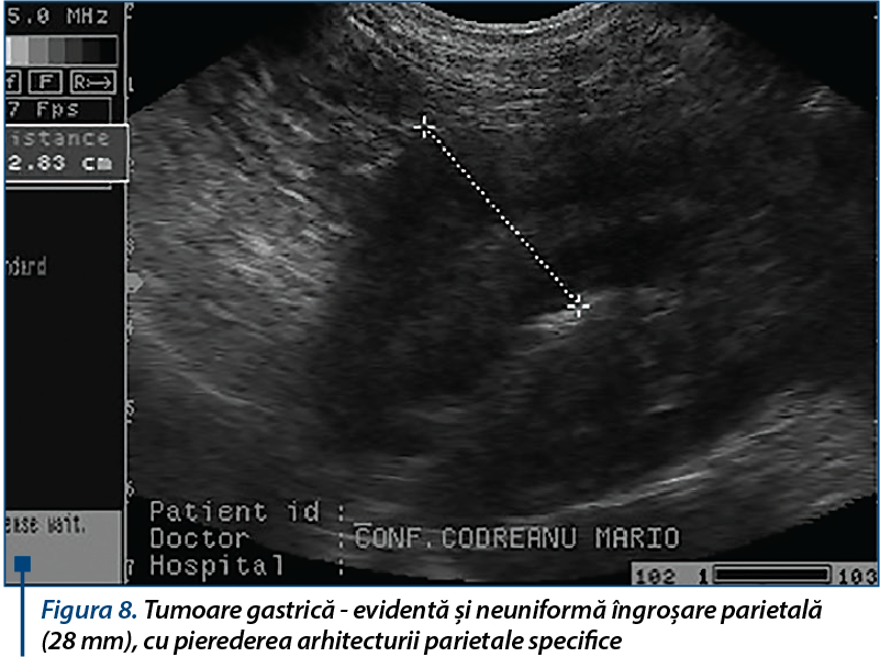 Figura 8. Tumoare gastrică - evidentă și neuniformă îngroșare parietală 