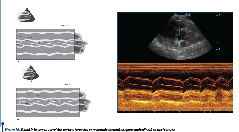 Figura 10. Modul M la nivelul valvulelor aortice. Fereastra parasternală dreaptă, secțiune logitudin