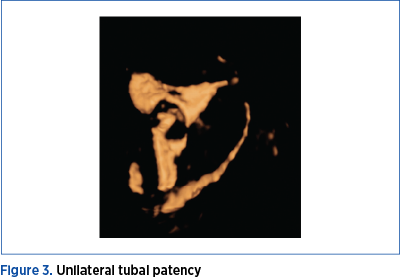 Figure 3. Unilateral tubal patency