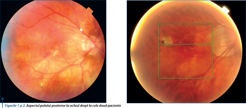 Figurile 1 şi 2. Aspectul polului posterior la ochiul drept la cele două paciente