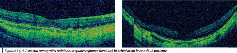 Figurile 3 şi 4. Aspectul tomografiei retiniene, secţiune: regiunea foveolară la ochiul drept la cele două paciente