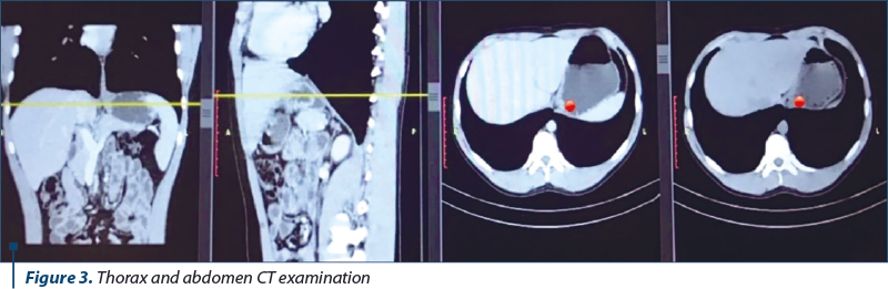 Figure 3. Thorax and abdomen CT examination