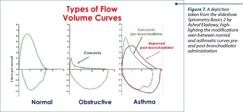 Figure 7. A depiction taken from the slideshow Spi­ro­metry Basics 2 by Ashraf Eladawy, high­lighting the modi­fi­cations seen between normal and asthmatic curves pre- and post-bronchodilator administration