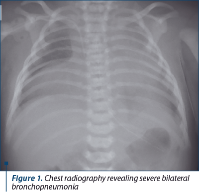 Figure 1. Chest radiography revealing severe bilateral bronchopneumonia