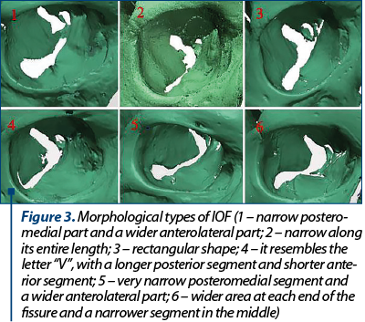 Figure 3. Morphological types of IOF (1 – narrow poste­ro­­­­­medial part and a wider anterolateral part; 2 – nar­row along its entire length; 3 – rectangular shape; 4 – it resembles the letter “V”, with a longer posterior seg­ment and shorter an­te­rior segment; 5 – very narrow postero­medial segment and a wider anterolateral part; 6 – wider area at each end of the fissure and a narrower seg­ment in the middle)