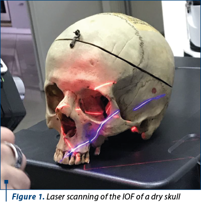 Figure 1. Laser scanning of the IOF of a dry skull