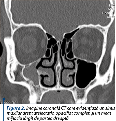 Figura 2. Imagine coronală CT care evidenţiază un sinus maxilar drept atelectatic, opacifiat complet, şi un meat mijlociu lărgit de partea dreaptă