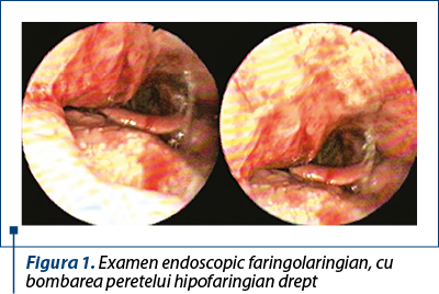 Figura 1. Examen endoscopic faringolaringian, cu bombarea peretelui hipofaringian drept