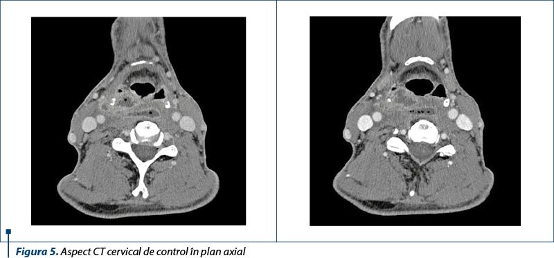 Figura 5. Aspect CT cervical de control în plan axial