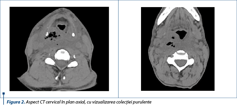 Figura 2. Aspect CT cervical în plan axial, cu vizualizarea colecţiei purulente