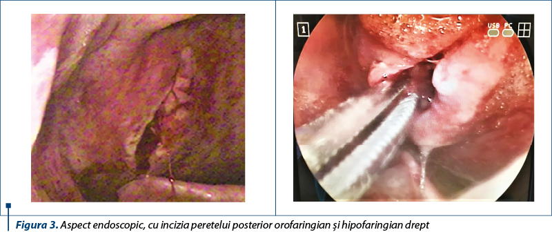Figura 3. Aspect endoscopic, cu incizia peretelui posterior orofaringian şi hipofaringian drept 