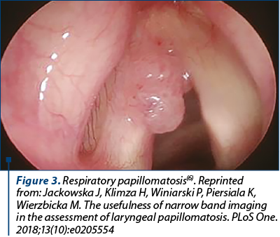 Figure 3. Respiratory papillomatosis(6). Reprinted from: Jackowska J, Klimza H, Winiarski P, Piersiala K, Wierzbicka M. The usefulness of narrow band imaging in the assessment of laryngeal papillomatosis. PLoS One. 2018;13(10):e0205554 