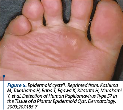 Figure 5. Epidermoid cysts(8). Reprinted from: Kashima M, Takahama H, Baba T, Egawa K, Kitasato H, Murakami Y, et al. Detection of Human Papillomavirus Type 57 in the Tissue of a Plantar Epidermoid Cyst. Dermatology. 2003;207:185-7
