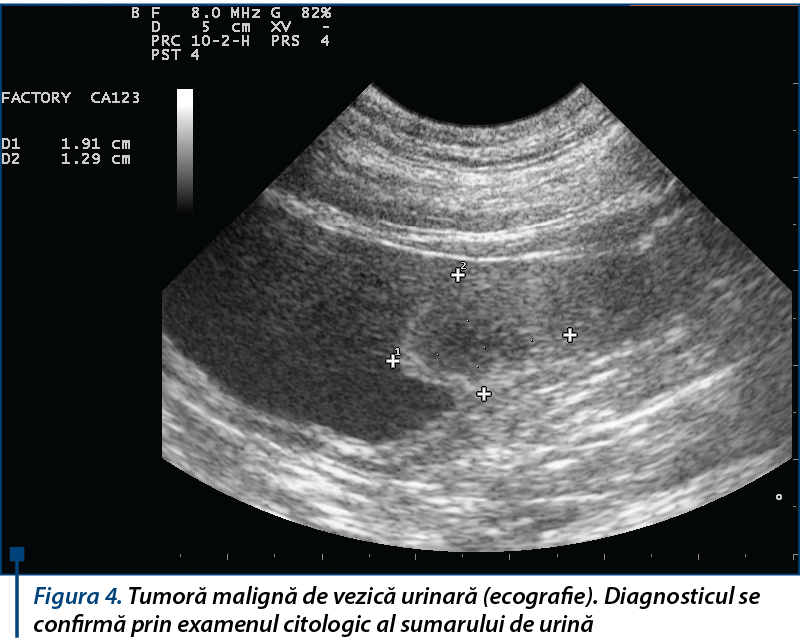 Figura 4. Tumoră malignă de vezică urinară (ecografie). Diagnosticul se confirmă prin examenul citol