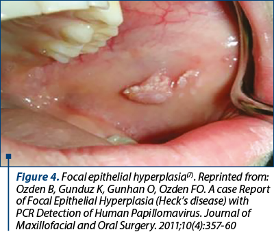Figure 4. Focal epithelial hyperplasia(7). Reprinted from: Ozden B, Gunduz K, Gunhan O, Ozden FO. A case Report of Focal Epithelial Hyperplasia (Heck’s disease) with PCR Detection of Human Papillomavirus. Journal of Maxillofacial and Oral Surgery. 2011;10(4):357-60 