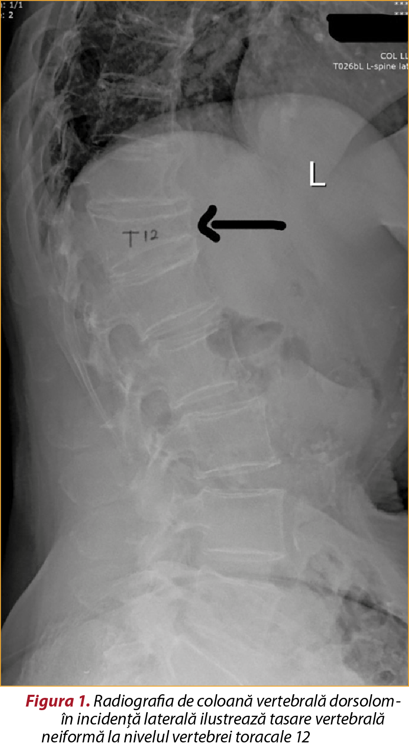 Figura 1. Radiografia de coloană vertebrală dorsolom­ba­ră în incidenţă laterală ilustrează tasare vertebrală cu­neiformă la nivelul vertebrei toracale 12