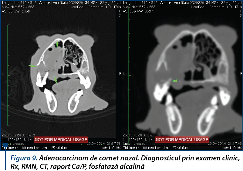 Figura 9. Adenocarcinom de cornet nazal. Diagnosticul prin examen clinic, Rx, RMN, CT, raport Ca P, 