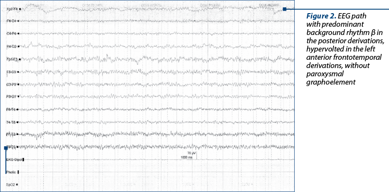 Figure 2. EEG path with predominant background rhythm β in the posterior derivations, hypervolted in the left anterior frontotemporal derivations, without paroxysmal graphoelement