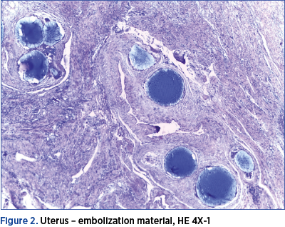 Figure 2. Uterus – embolization material, HE 4X-1