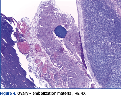 Figure 4. Ovary – embolization material, HE 4X