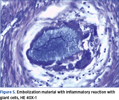 Figure 5. Embolization material with inflammatory reaction with giant cells, HE 40X-1