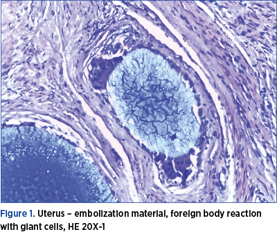 Figure 1. Uterus – embolization material, foreign body reaction with giant cells, HE 20X-1