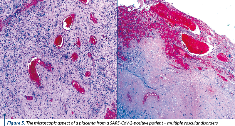 Figure 5. The microscopic aspect of a placenta from a SARS-CoV-2-positive patient – multiple vascular disorders