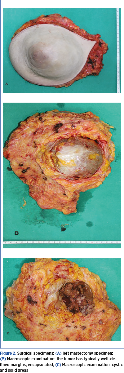 Figure 2. Surgical specimens: (A) left mastectomy specimen;  (B) Macroscopic examination: the tumor has typically well-defined margins, encapsulated; (C) Macroscopic examination: cystic and solid areas