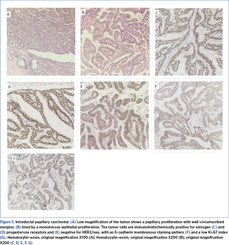 Figure 3. Intraductal papillary carcinoma: (A) Low magnification of the tumor shows a papillary proliferation with well-circumscribed margins; (B) lined by a monotonous epithelial proliferation. The tumor cells are immunohistochemically positive for estrogen (C) and (D) progesterone receptors and (E) negative for HER2/neu, with an E-cadherin membranous staining pattern (F) and a low Ki-67 index (G). Hematoxylin-eosin, original magnification X100 (A); Hematoxylin-eosin, original magnification X200 (B); original magnification X200 (C, D, E, F, G)