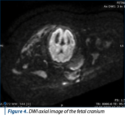 Figure 4. DWI axial image of the fetal cranium