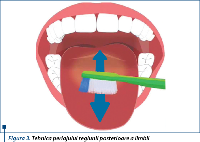 Figura 3. Tehnica periajului regiunii posterioare a limbii