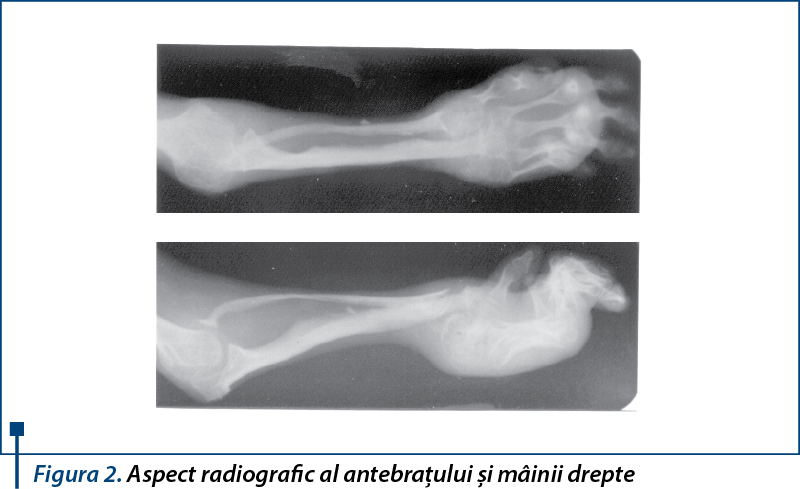 Figura 2. Aspect radiografic al antebraţului şi mâinii drepte