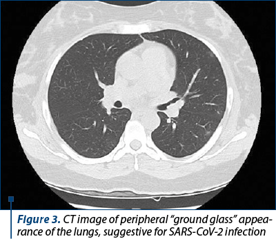 Figure 3. CT image of peripheral “ground glass” appea­rance of the lungs, suggestive for SARS-CoV-2 infection