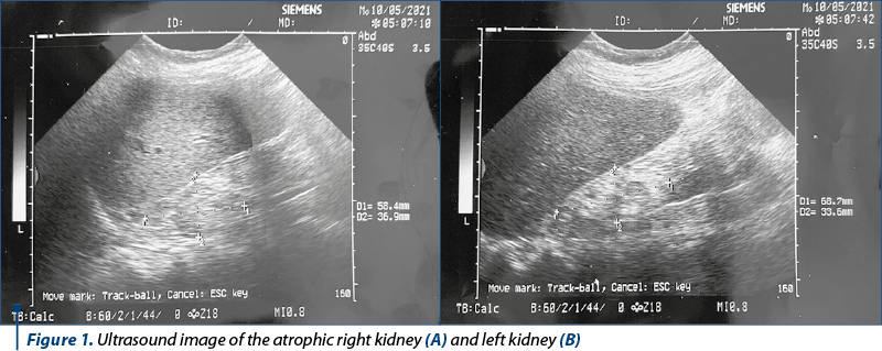 Figure 1. Ultrasound image of the atrophic right kidney (A) and left kidney (B)