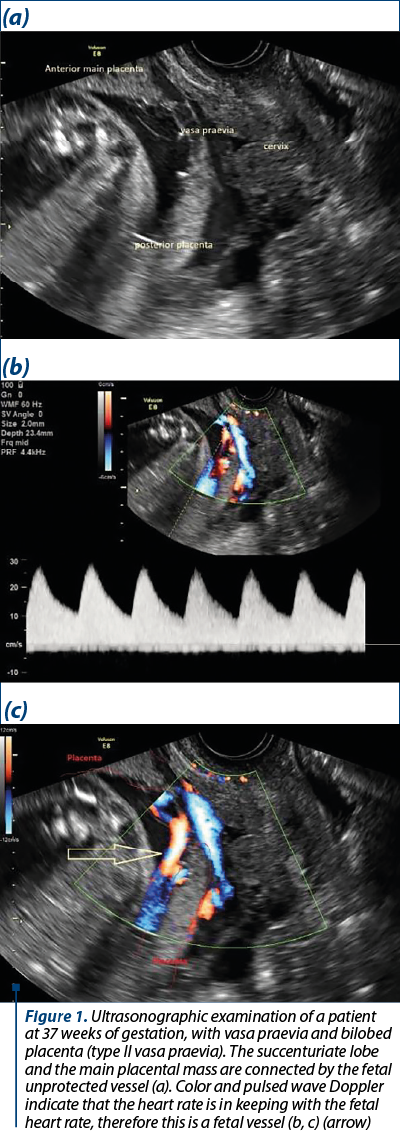 Figure 1. Ultrasonographic examination of a patient at 37 weeks of gestation, with vasa praevia and bilobed placenta (type II vasa praevia). The succenturiate lobe and the main placental mass are connected by the fetal unprotected vessel (a). Color and pulsed wave Doppler indicate that the heart rate is in keeping with the fetal heart rate, therefore this is a fetal vessel (b, c) (arrow) 