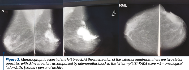 Figure 3. Mammographic aspect of the left breast. At the intersection of the external quadrants, there are two stellar opacities, with skin retraction, accompanied by adenopathic block in the left armpit (BI-RADS score = 5 – oncological lesions). Dr. Şerboiu’s personal archive
