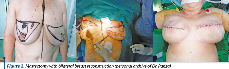 Figure 2. Mastectomy with bilateral breast reconstruction (personal archive of Dr. Pariza)