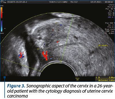 Figure 3. Sonographic aspect of the cervix in a 26-year-old patient with the cytology diagnosis of uterine cervix carcinoma