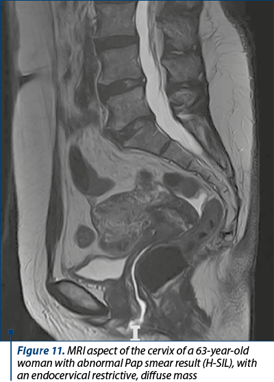Figure 11. MRI aspect of the cervix of a 63-year-old woman with abnormal Pap smear result (H-SIL), with  an endocervical restrictive, diffuse mass 